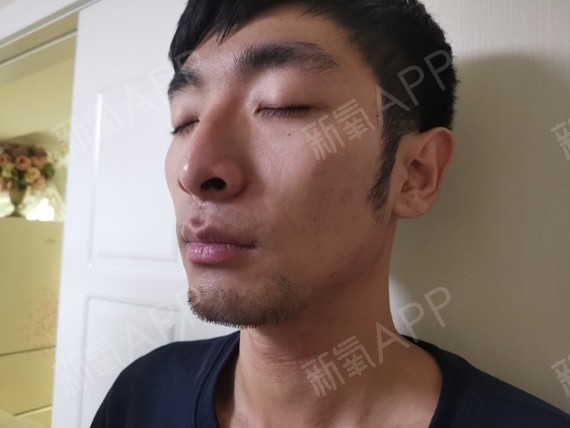 湖南脱络腮胡多少钱 脱络腮胡用什么脱毛仪比较好